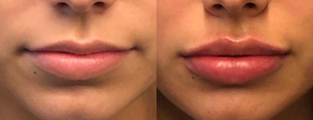 Lip Dermal Fillers Before & After